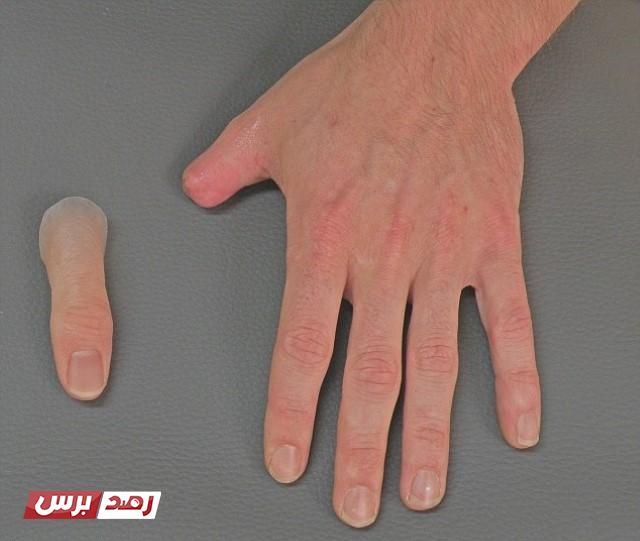 الاطراف الصناعية المصنوعة من السيليكون الطبي لتعويض بتر الاصابع